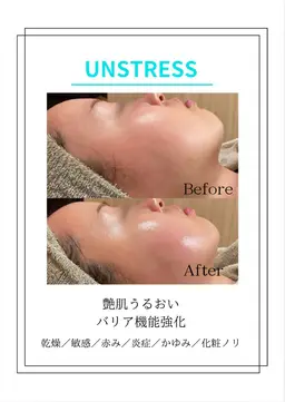 アンストレス乳酸菌ピーリング【乾燥/敏感肌】¥16,500→¥11,000 水分、艶肌トリートメント