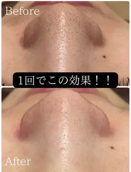 導入記念価格！鼻の黒ずみ改善！！全顔ハイドラ毛穴洗浄！※当店のハイドラ毛穴洗浄が初めての方限定