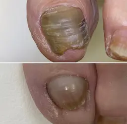 変形爪の再生補正モデルさん