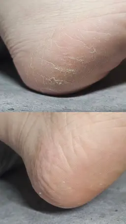 🦶足裏角質ケアモニター様募集中✨️