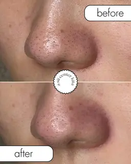 最新毛穴洗浄🫧美容成分を含んだトルネード水流の最新ピーリング💫黒ずみや開き毛穴、お肌のゴワつきにも◉炭酸ガスパック付