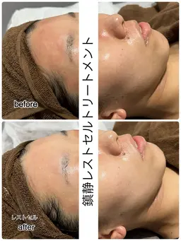 【圧倒的透明感】美肌鎮静トリートメント🐹✨14300→13000