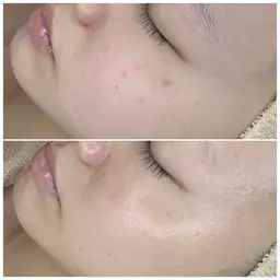 【シミの量が少なめな方】シミデトックストリートメント70分