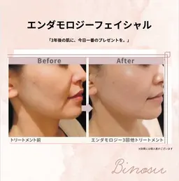 《毛穴/艶肌/ハリ》エンダモロジーフェイシャル×ハイドラ毛穴洗浄×パック★