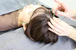 小顔むくみスッキリ美容鍼＋血流トリートメント＋首ヘッドマッサージ