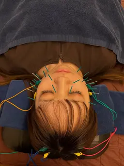 【当日限定】💆🏻♀️美容鍼+ヘッドマッサージ 70分 (施術50分+カウンセリングホームケア指導20分)