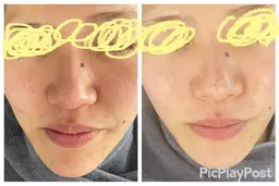 【角質除去】お肌に優しいとり過ぎないピーリング💎