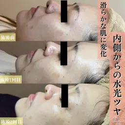 【半額クーポン】ハイドラ+スノーピーリング