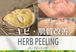 今だけ限定50%off❣️【お試しWハーブピーリング+肌チェック🌿90分¥9900】ニキビ/毛穴/肌質改善/くすみ