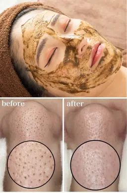 【今月限定人気No1★医師推奨/本格肌改善】幹細胞入りの独自のハーブピーリング×鼻ハイドラフェイシャル　赤ちゃん👶肌へ