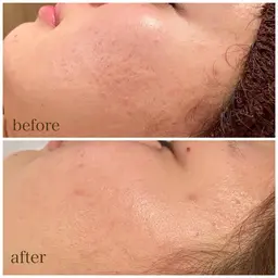 剥けない痛くないのに効果抜群❣️ハーブピーリング✳︎【軽度〜中度】1.5g🌿