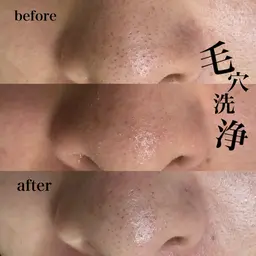 【毛穴黒ずみ撃退💥】韓国式美肌毛穴洗浄 -鼻のみ👃🏻-