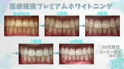 💚医療提携プレミアムセルフホワイトニング💚30分