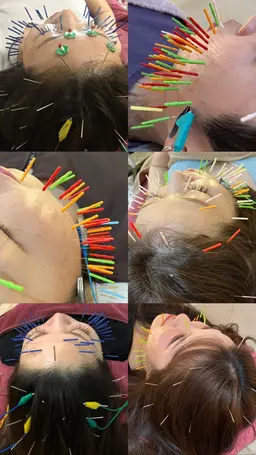 人気No.①✨女優鍼コース✨しっかり小顔美容鍼電気鍼コース💜※初めての方にもオススメです^ ^