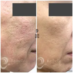 特別初回モニターハーブピーリング