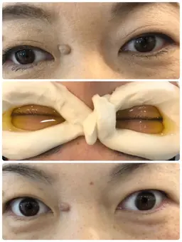 眼球エステ ネトラバスティ  眼精疲労 ドライアイ 白目クリーニング