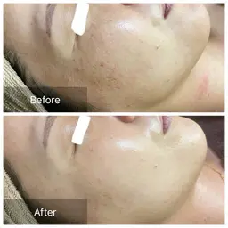 【ニキビ/毛穴改善】ハーブピーリング🌿.∘