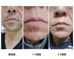 【メンズ髭脱毛】スキンケア付きだからお肌もスッキリ✨