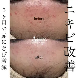 No.1人気★REVIハーブピーリング(ダウンタイム無) +再生因子+LEDフェイシャル