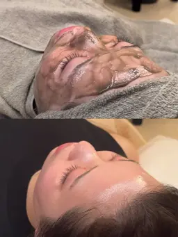 【艶肌・ニキビケア】-フェイスwaxとお肌に優しいハーブピーリングで健康的な艶肌に🌿剥離せず、ダウンタイムもありません