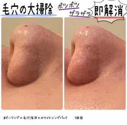 ニキビケア/化粧崩れ卒業🙆‍♀️✨ソフトピーリング毛穴洗浄+ホワイトクリアパック¥5,500