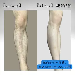 【脱毛】ひざ下光脱毛🦵【男女可】
