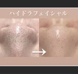 【口コミ投稿限定】毛穴洗浄コース　黒ずみ/いちご鼻に👃濃密ホワイトハニーで美肌へ♪