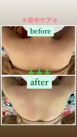 🔹minimo限定🥰🔹 ⚠️背中ケア➕お顔のケア方法のセットメニューなります ⚠️背中美人＆美肌になりませんか❓