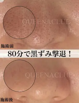 【12月10日12時30分15時限定】毛穴改善ケア￥8800長年のいちご鼻から卒業/毛穴のザラつき/黒ずみ/毛穴の開き