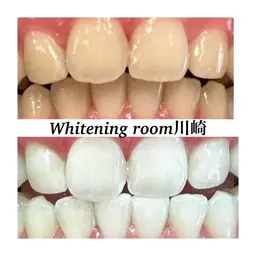 【ミニモ学割】学生限定★ セルフホワイトニング30分照射×3回コース　回数券🦷💎