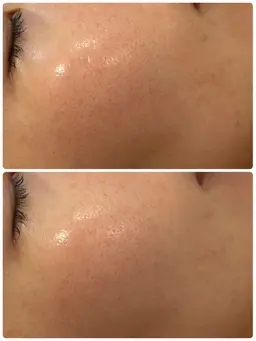 【美肌フェイシャル💆‍♀️】毛穴洗浄&美容液導入　美白エイジング✨全世代のお悩みに