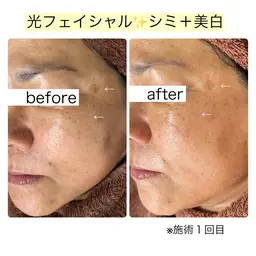 光フェイシャル