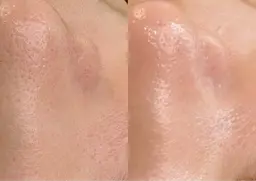 ＜ファンデいらずのツヤ肌へ＞美白＆保湿フェイシャルWAX ¥10,000→¥4,400