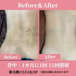 【女性限定/スタッフ施術】お顔/VIO/全身脱毛☆極上美肌脱毛コース