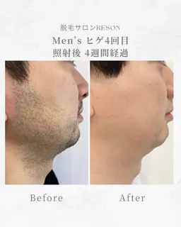 メンズ ヒゲ脱毛