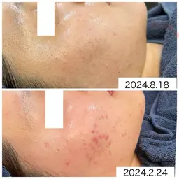 【脱！ニキビ、赤み、凸凹、肌トラブル/炎症ニキビ＆本気の肌質改善ケア】　角質ケア×幹細胞入り炭酸パック！メンズ◎