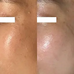 【人気SET🔥】ピーリング＋シミ改善🪄肌の土台からトーンUP✨