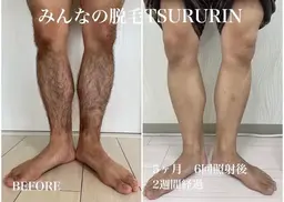 初回限定🌟男性脚or腕セット脱毛👨通常¥10,000→¥5,000‼️（肘上下•手甲指）or（膝上下•足甲指）