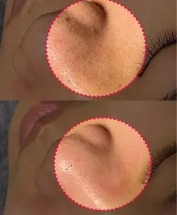 【毛穴・黒ずみに！】美容液で吸引！ハイドロ毛穴洗浄ツルスベに驚き☆