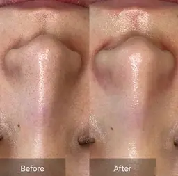 【毛穴レスフェイシャル】✨️気になる黒ずみや角栓をごっそり除去‼️