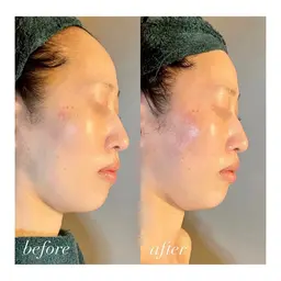 人気NO.1👑頭皮もお顔もダブルでEMSで徹底的にひきあげ!!プレエイジングケアにもオススメ✨️