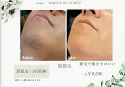 🖤ミニモ限定🥀　初回限定🧼💞ヒゲ脱毛🌟