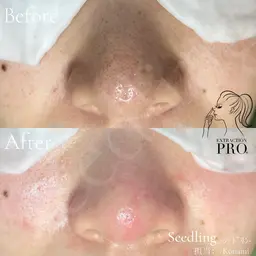 毛穴エクストラクション★いちご鼻を徹底ケア！