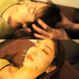 🉐ミニモ限定🉐【美容鍼+小顔矯正】全体的なお顔の悩みが気になる方におすすめ