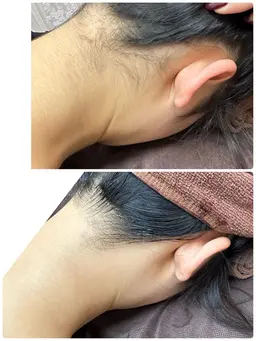 《うなじ脱毛✨》