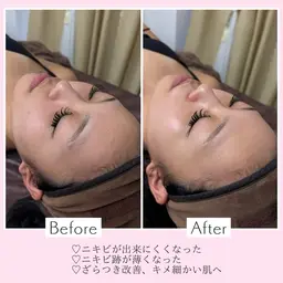 うるツヤ韓国ピーリング🇰🇷‪‪♡(剥離なし)