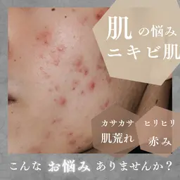 ハーブピーリング