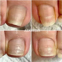 【ご新規様】【初回】巻き爪矯正✴︎痛みからの解放🦶足の巻き爪でお困りの方