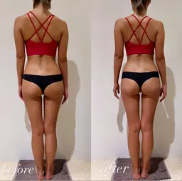 【足痩せ🦵🏻痩身ダイエットメニュー】ラジオ波キャビテーションで浮腫みを除去✨骨盤矯正/ヒップアップしたい方にオススメ