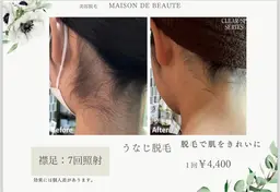 【🍉夏限定🌊】うなじ脱毛🌈🦴